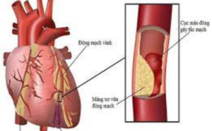 Cơn đau thắt ngực không ổn định