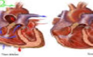 Bệnh tim chữa được không