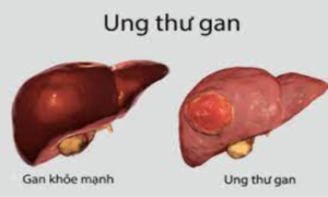 9 dấu hiệu ung thư gan giai đoạn đầu